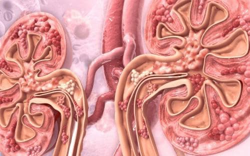 Proteinuria en gammapatías monoclonales