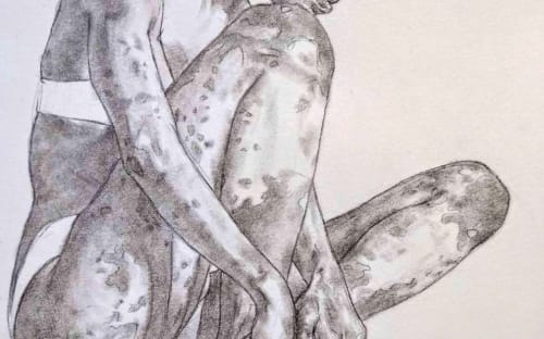 Síndrome Poliglandular Autoinmune Tipo III C