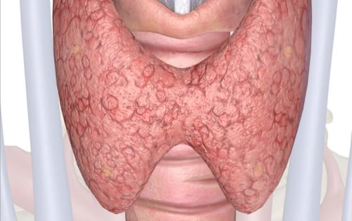 Hipertiroidismo en el embarazo