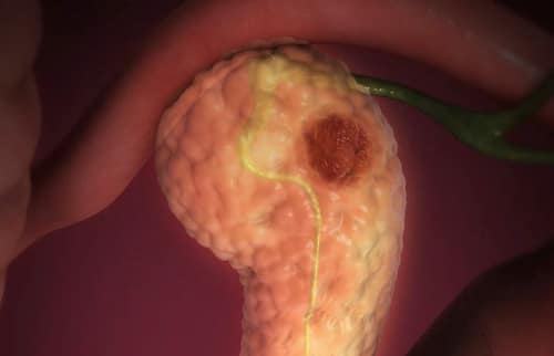 Pancreatitis Aguda: Evidencia Actual