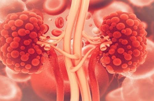 Utilidad de los parámetros urinarios en la enfermedad renal crónica avanzada