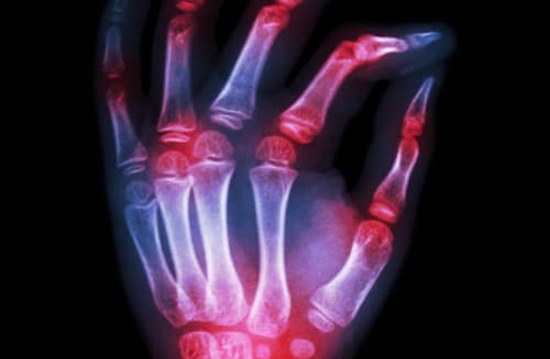 Eficacia diagnóstica de anticuerpos antipéptidos citrulinados de segunda y tercera generaciones para la artritis reumatoide