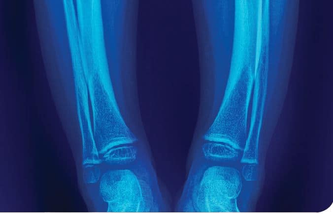 Diagnóstico diferencial del raquitismo hipocalcémico