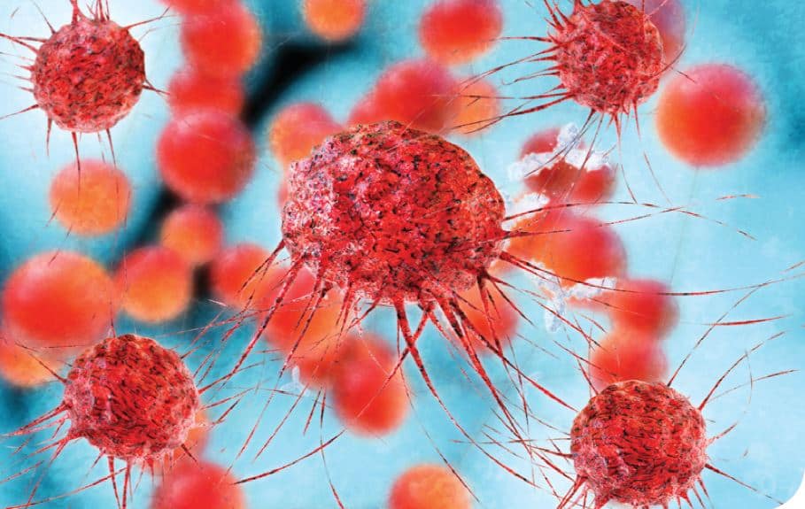 Síndrome de Lynch: selección de pacientes para el estudio genético mediante análisis de inestabilidad microsatelital e inmunohistoquímica