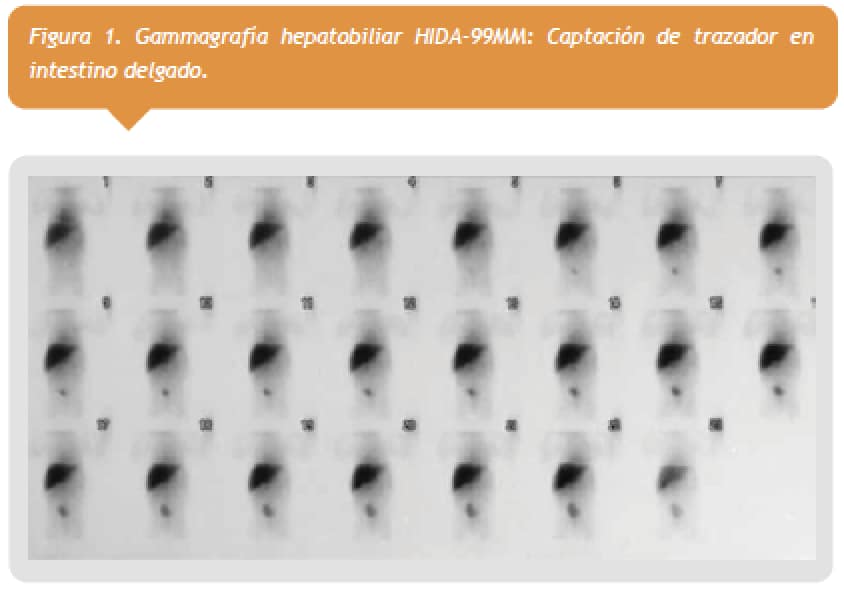 Figura 1-Gammagrafia